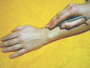 Ausführung der Akupunkt-Massage